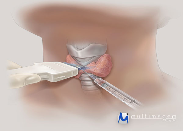 Se o nódulo crescer, pode ser que precise ser puncionado com uma agulha fina (PAAF)